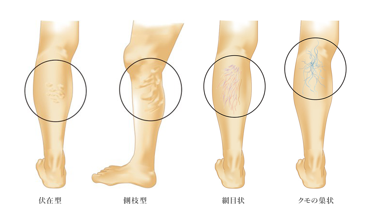 下肢静脈瘤とは
