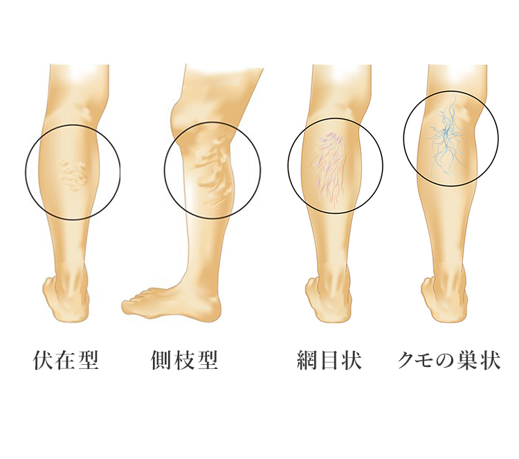 下肢静脈瘤とは