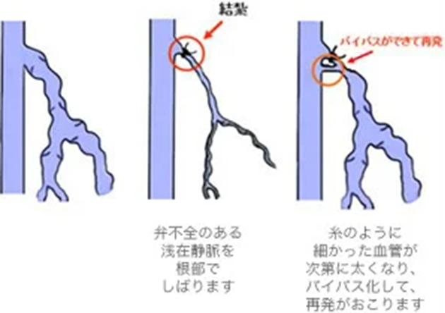 高位結紮