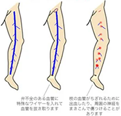 ストリッピング